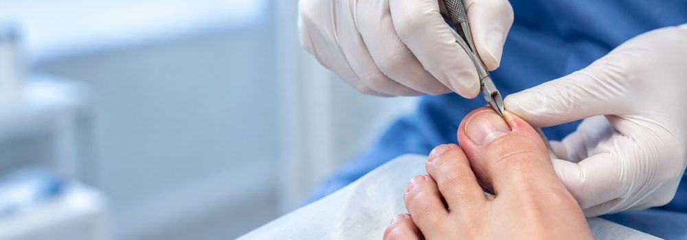 How to Choose the Right Footcare Specialist for Ingrown Toenail Treatment