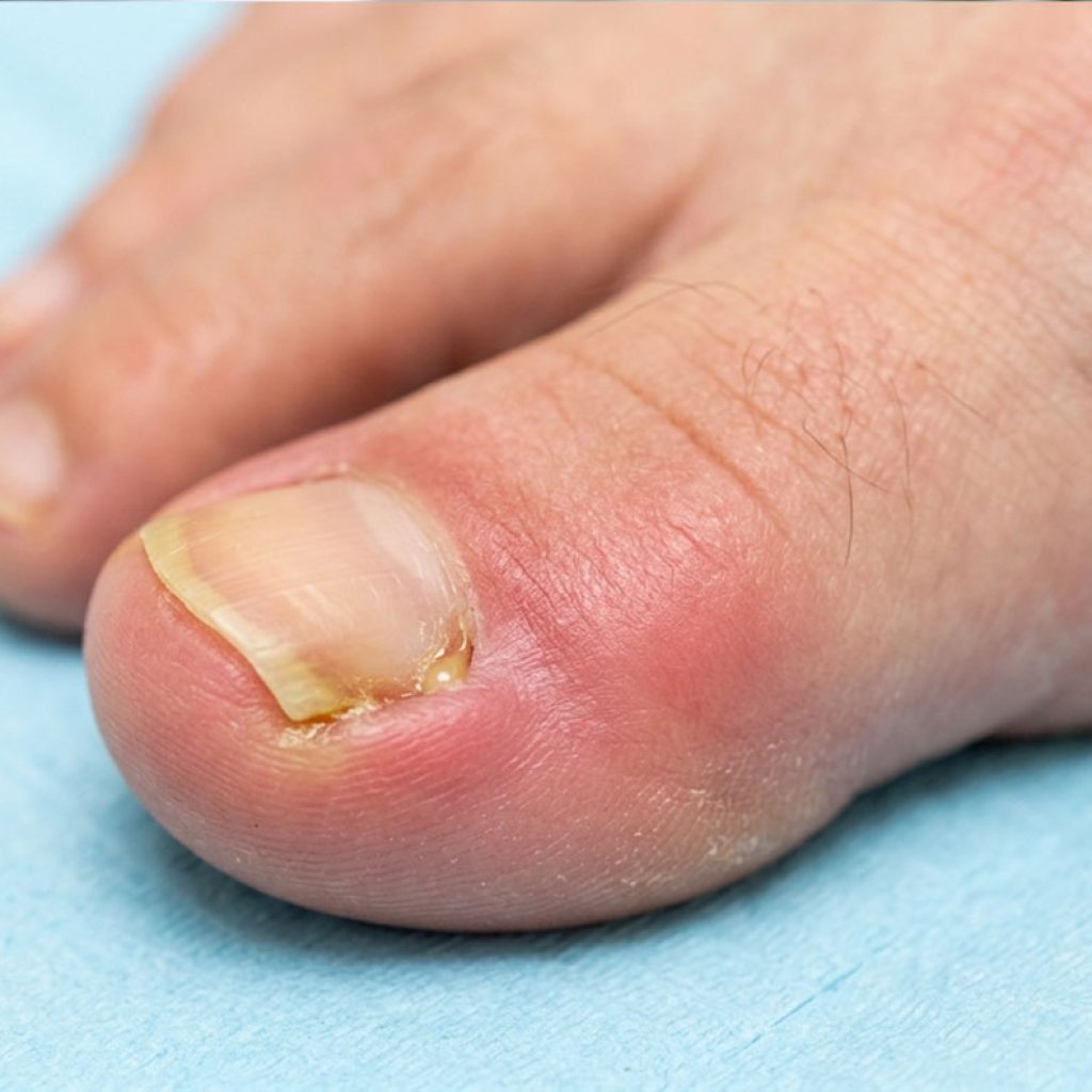 Ingown Toenail