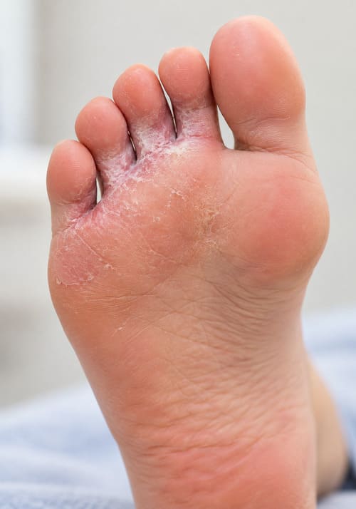 Athlete's Foot